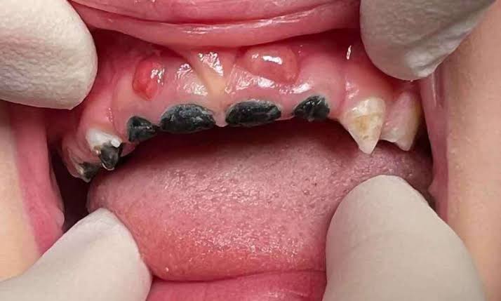 Baby Teeth Cavities: Why Rancho Cucamonga Parents Should Take Early Childhood Tooth Decay Seriously